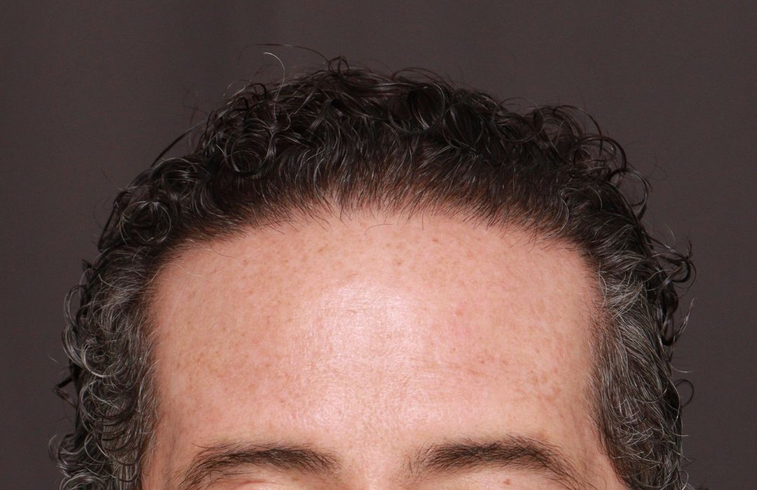 After Image: FUT Hair Transplant by Dr. Thompson - front