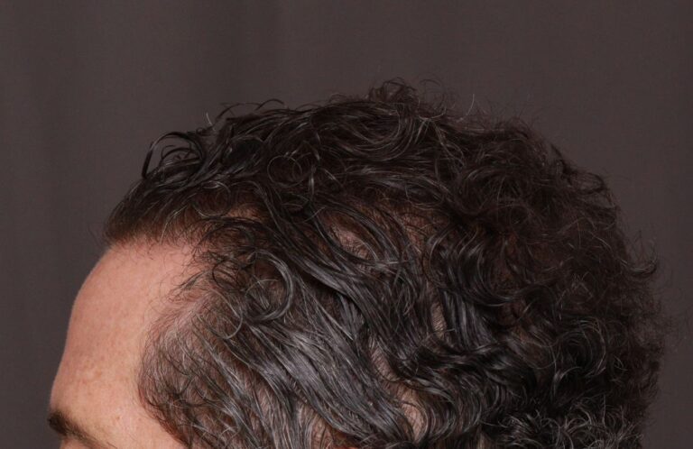After Image: FUT Hair Transplant by Dr. Thompson - left-side