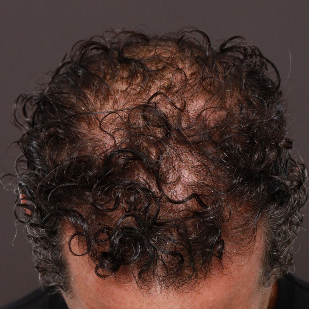 Before Image: FUT Hair Transplant by Dr. Thompson - front
