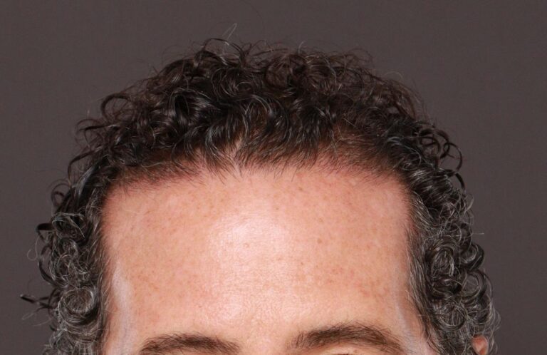 Before Image: FUT Hair Transplant by Dr. Thompson - front