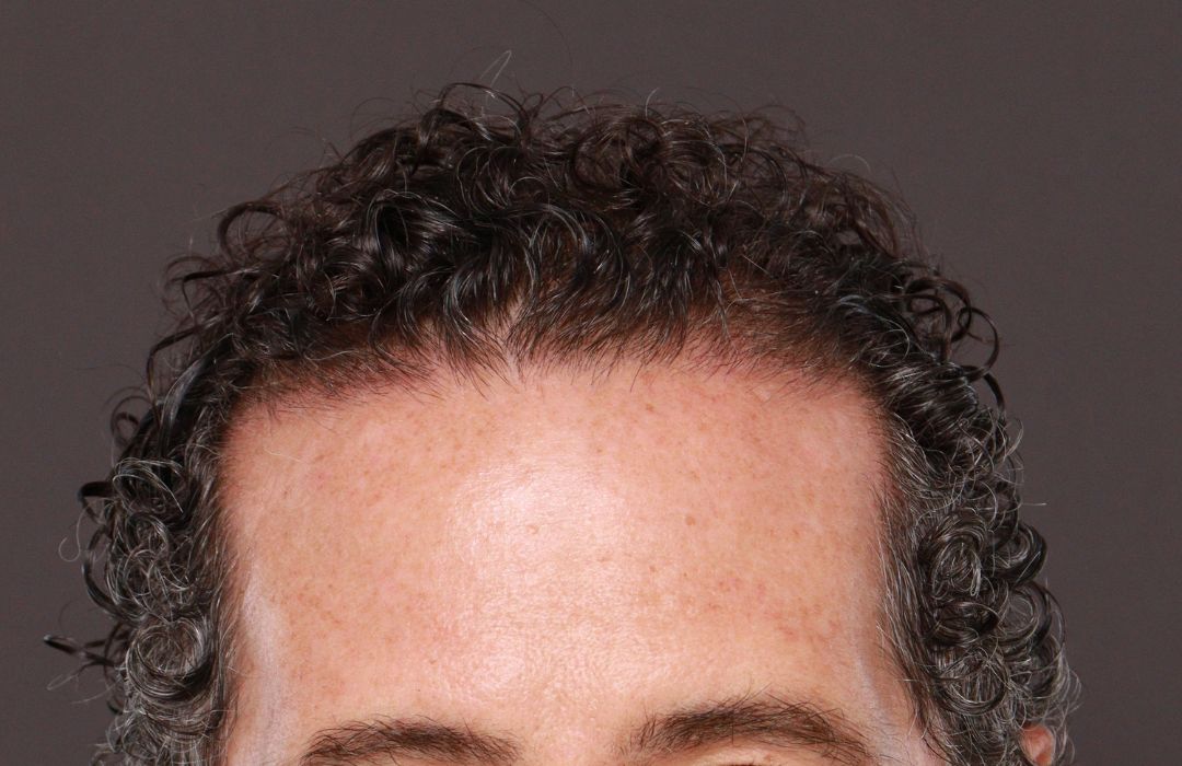 Before Image: FUT Hair Transplant by Dr. Thompson - front