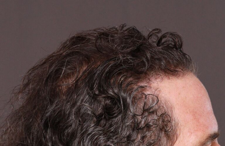 Before Image: FUT Hair Transplant by Dr. Thompson - right-side