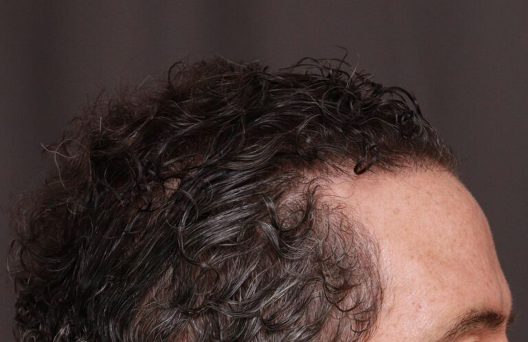 After Image: FUT Hair Transplant by Dr. Thompson - right-side