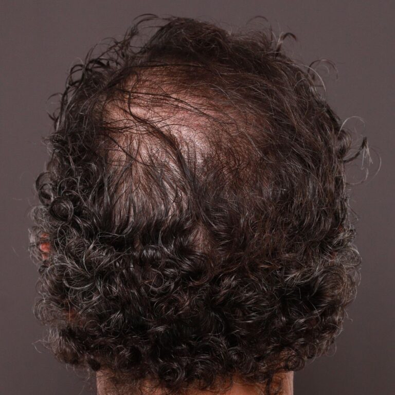 Before Image: FUT Hair Transplant by Dr. Thompson - back