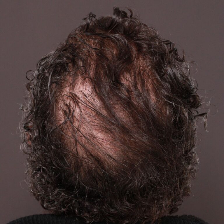 Before Image: FUT Hair Transplant by Dr. Thompson - back
