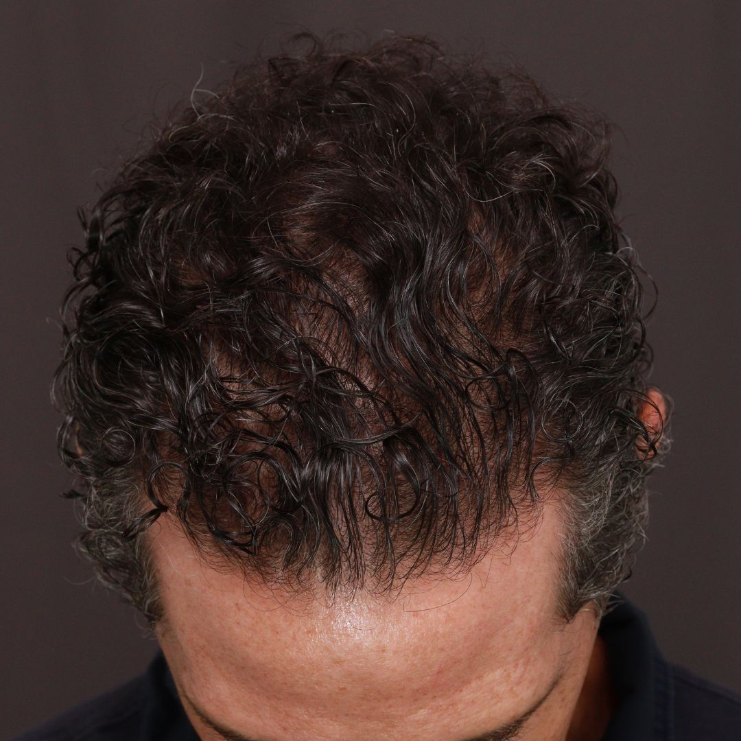 After Image: FUT Hair Transplant by Dr. Thompson - front
