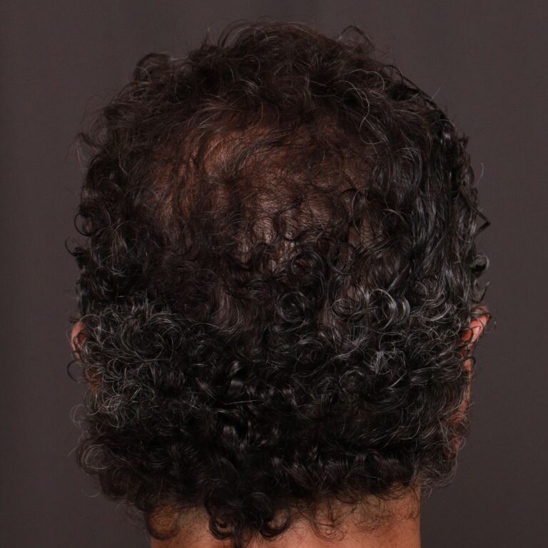 After Image: FUT Hair Transplant by Dr. Thompson - back