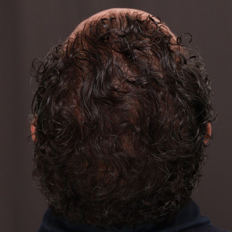 After Image: FUT Hair Transplant by Dr. Thompson - back