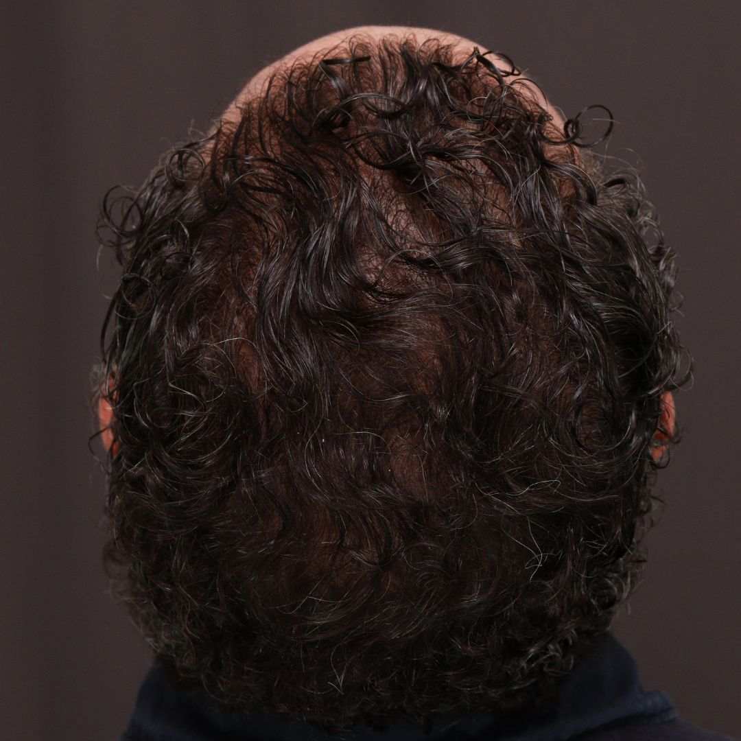 After Image: FUT Hair Transplant by Dr. Thompson - back