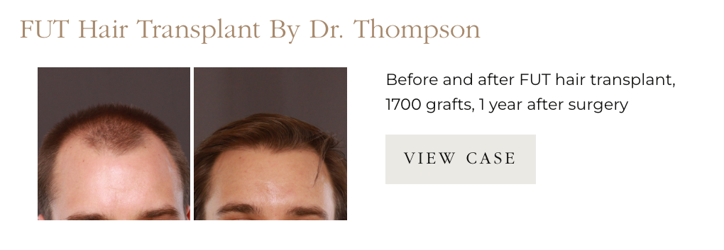 FUT Hair Transplant Before and After results at UFP Hair Restoration