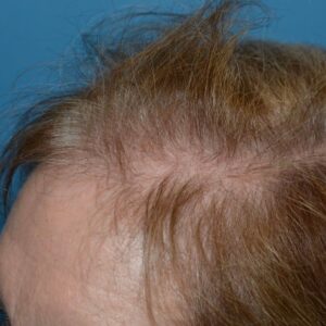 Female Hair Loss Female Hair Loss