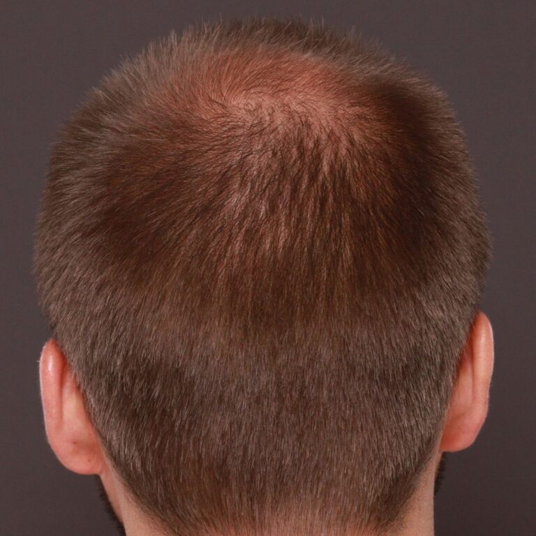 Before Image: FUT Hair Transplant by Dr. Thompson - back