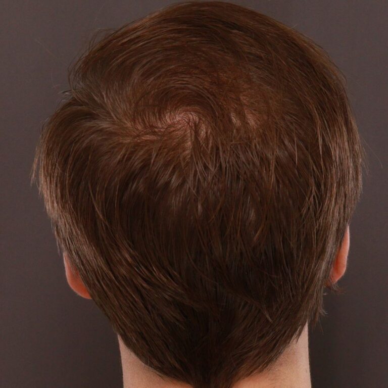 After Image: FUT Hair Transplant by Dr. Thompson - back