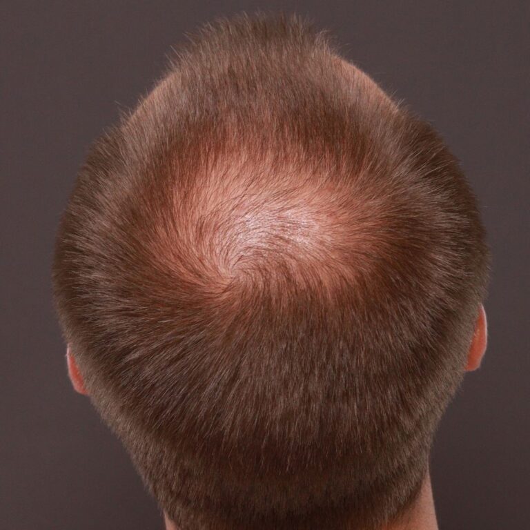 Before Image: FUT Hair Transplant by Dr. Thompson - back