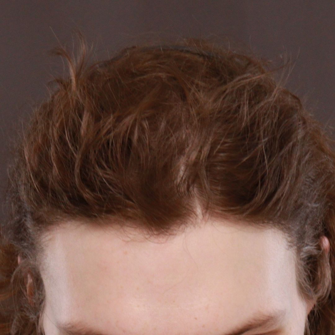 After Image: FUT Hair Transplant by Dr. Henstrom - front