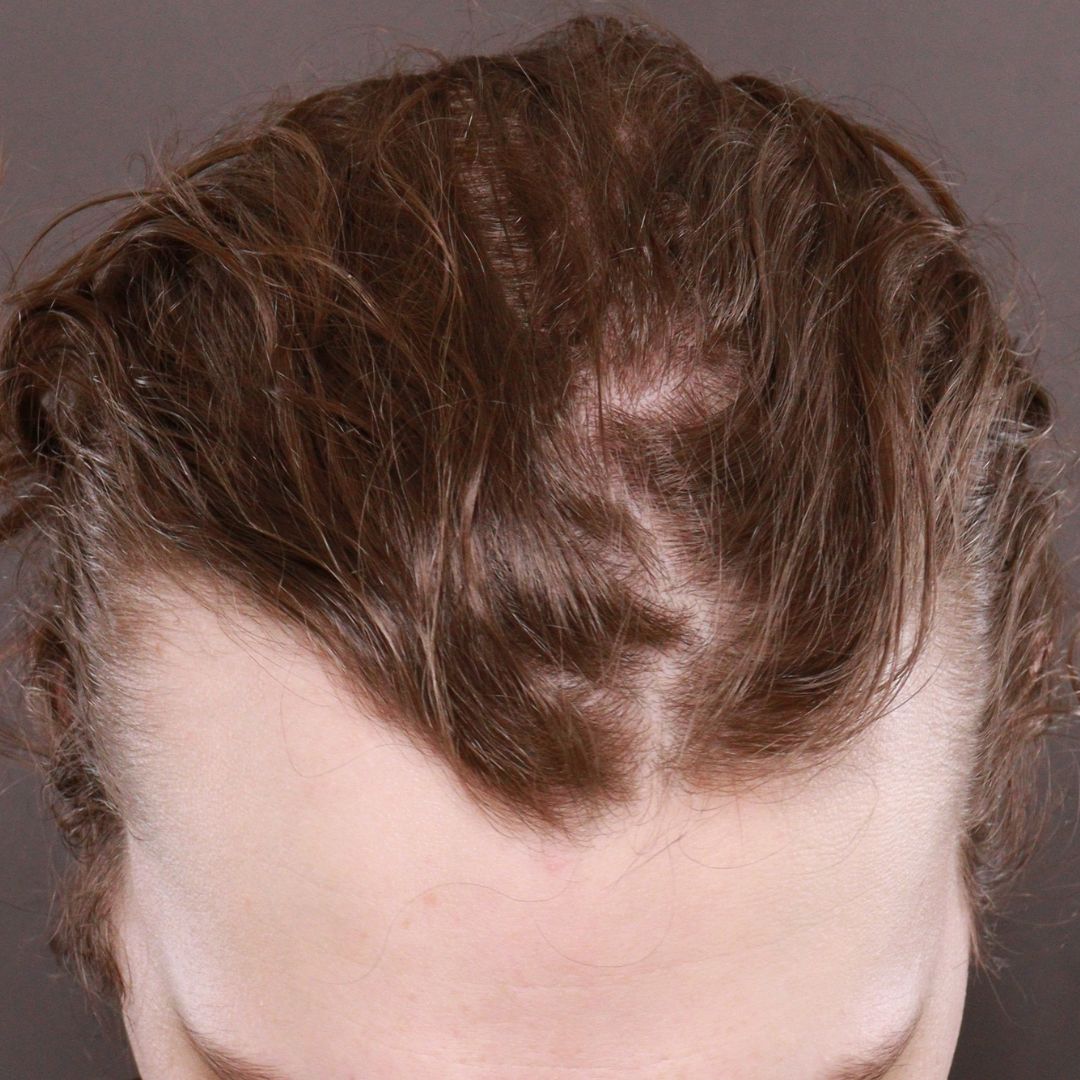 Before Image: FUT Hair Transplant by Dr. Henstrom - front