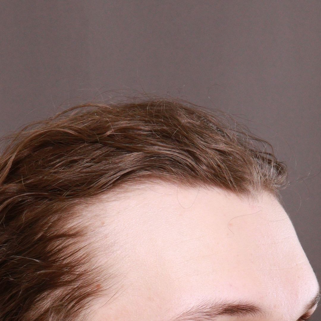 Before Image: FUT Hair Transplant by Dr. Henstrom - right-front-oblique
