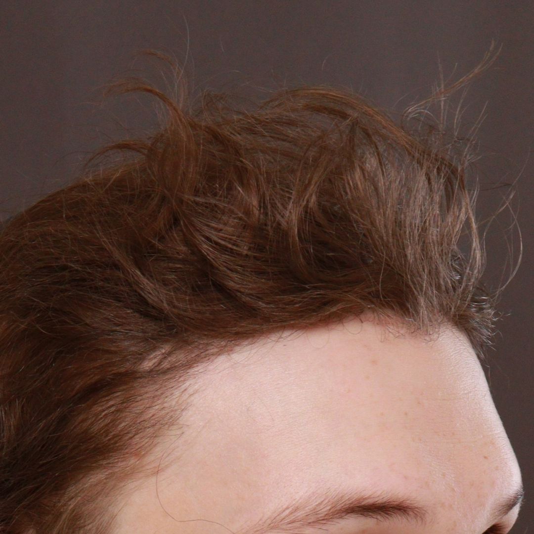 After Image: FUT Hair Transplant by Dr. Henstrom - right-front-oblique