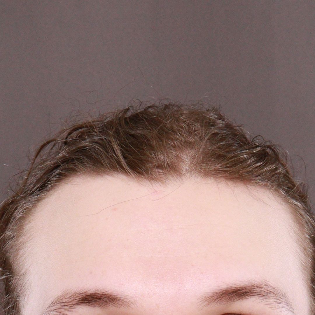 Before Image: FUT Hair Transplant by Dr. Henstrom - front