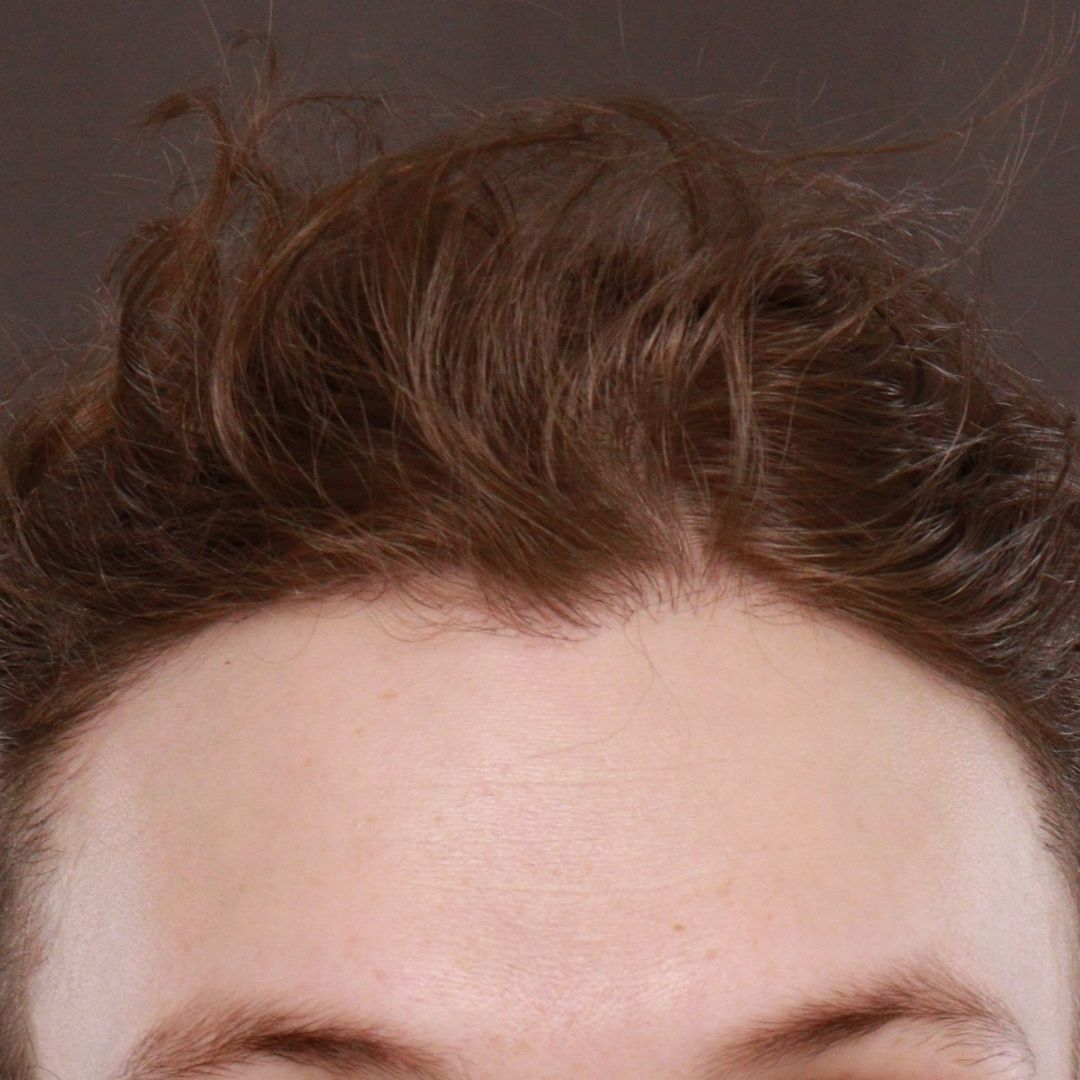 After Image: FUT Hair Transplant by Dr. Henstrom - front