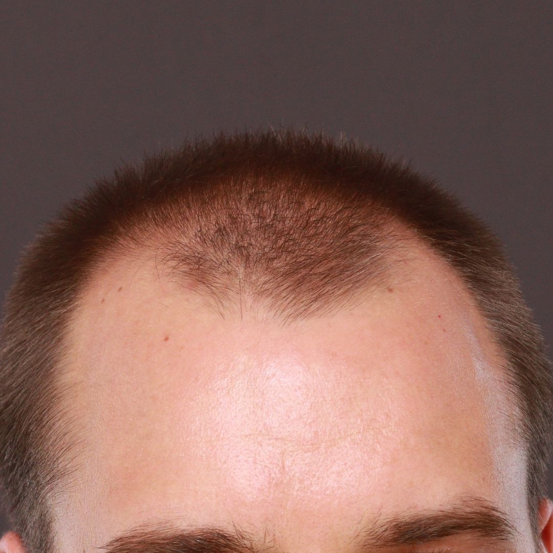 Before Image: FUT Hair Transplant by Dr. Thompson - front
