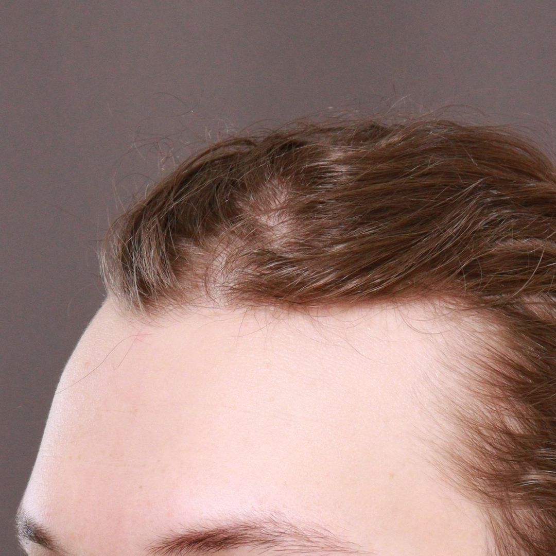 Before Image: FUT Hair Transplant by Dr. Henstrom - left-front-oblique