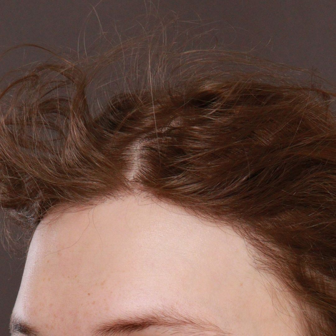 After Image: FUT Hair Transplant by Dr. Henstrom - left-front-oblique