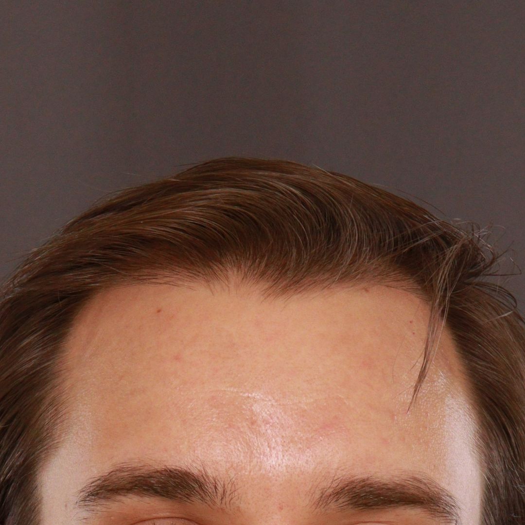 After Image: FUT Hair Transplant by Dr. Thompson - front