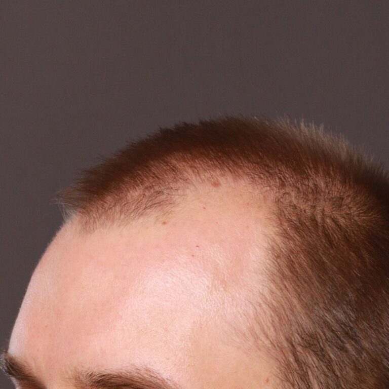 Before Image: FUT Hair Transplant by Dr. Thompson - left-front-oblique