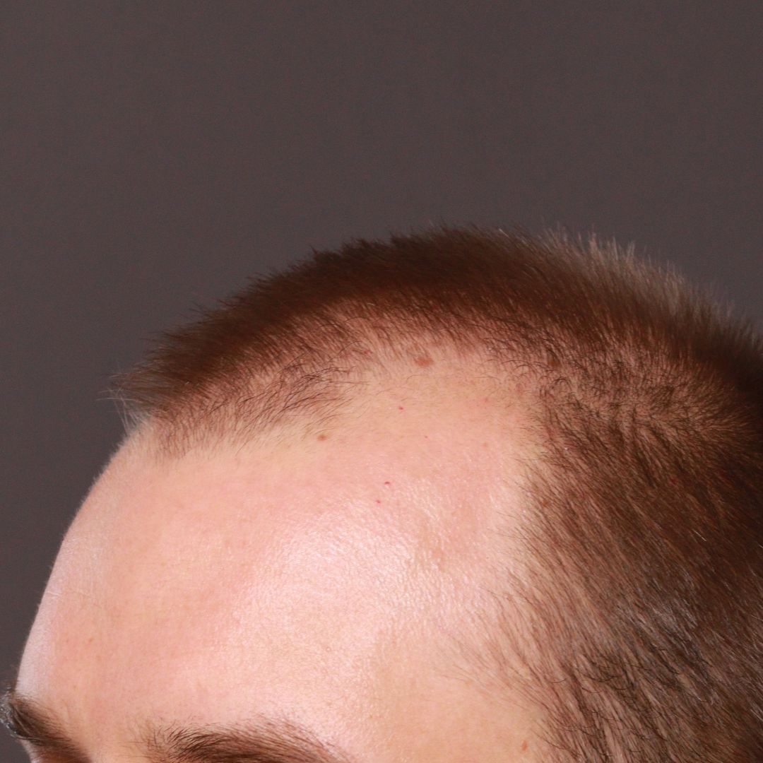 Before Image: FUT Hair Transplant by Dr. Thompson - left-front-oblique