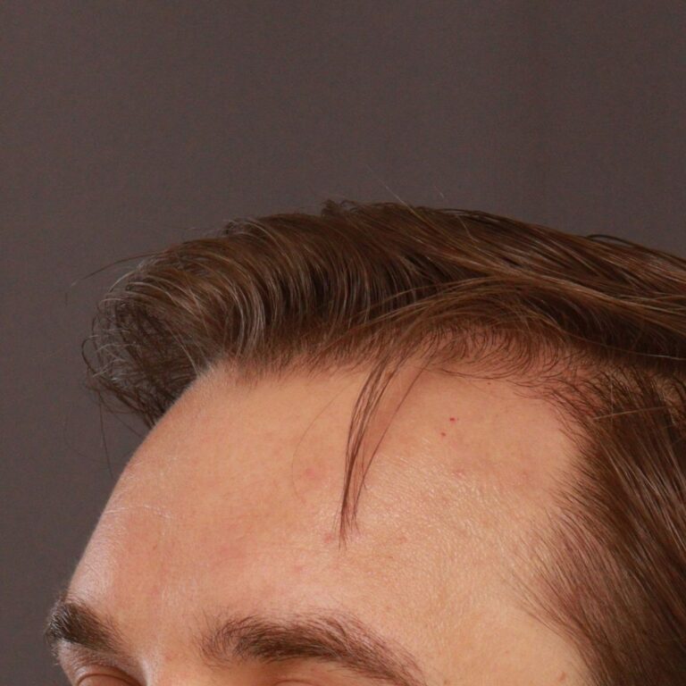 After Image: FUT Hair Transplant by Dr. Thompson - left-front-oblique