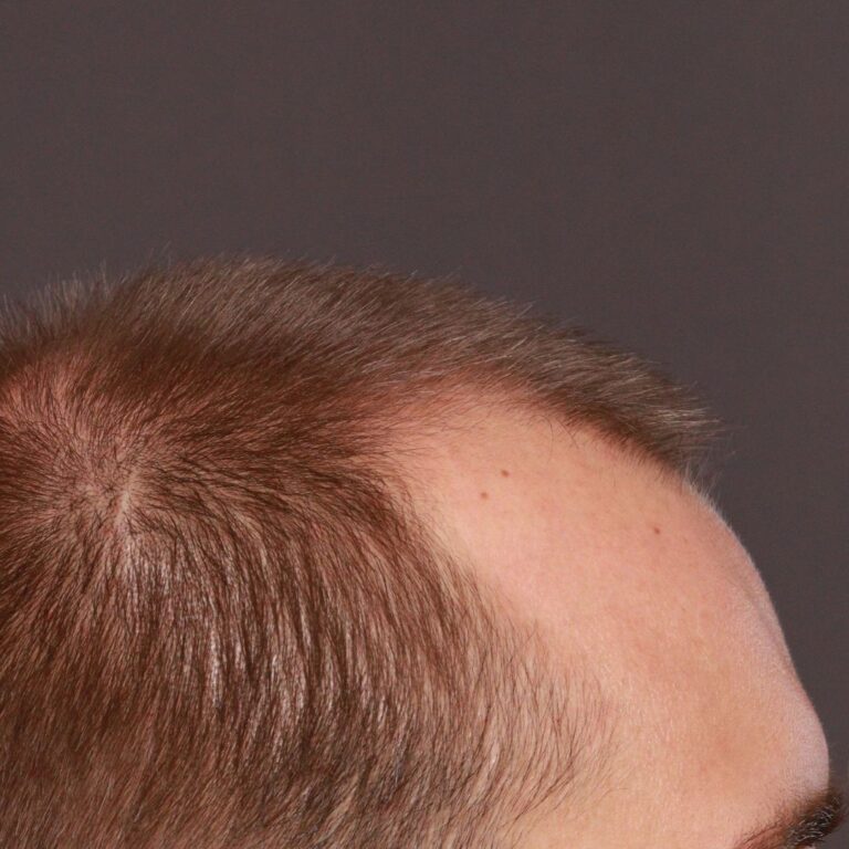 Before Image: FUT Hair Transplant by Dr. Thompson - right-side