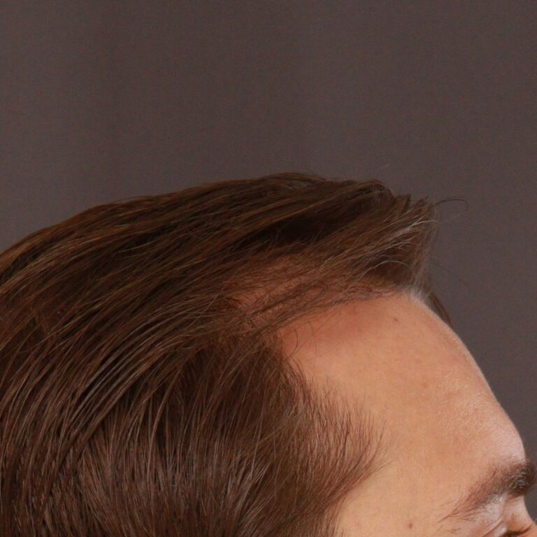 After Image: FUT Hair Transplant by Dr. Thompson - right-side