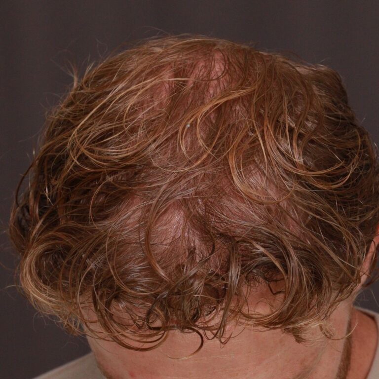 After Image: FUE Hair Transplant by Dr. Manning - front