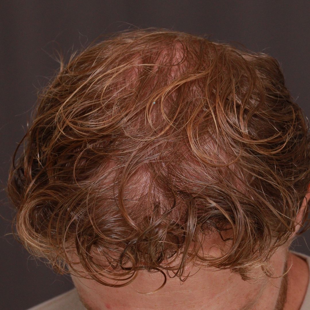 After Image: FUE Hair Transplant by Dr. Manning - front