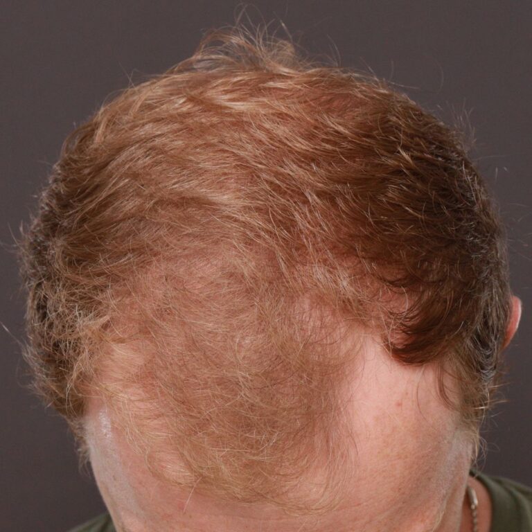 Before Image: FUE Hair Transplant by Dr. Manning - front