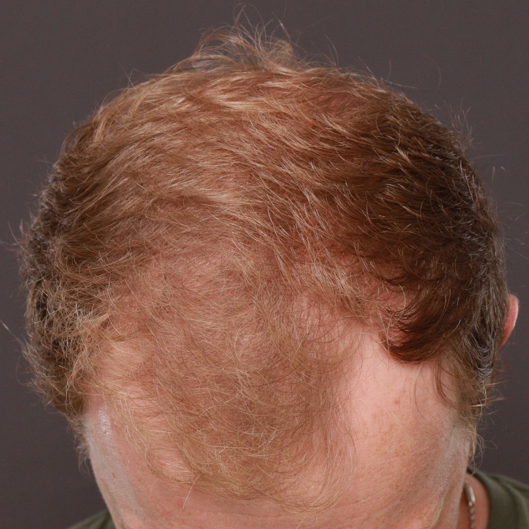Before Image: FUE Hair Transplant by Dr. Manning - front