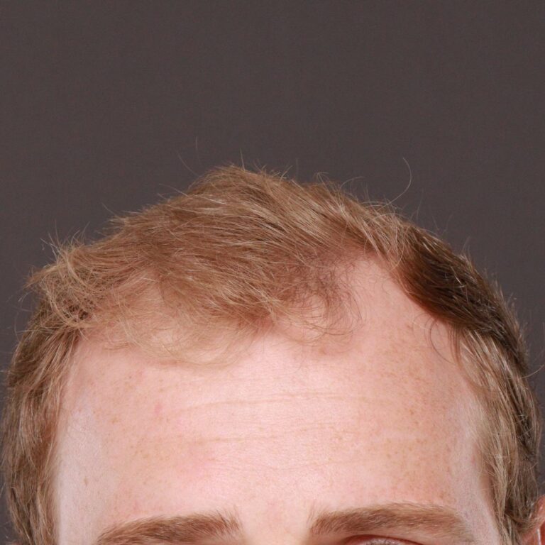 Before Image: FUE Hair Transplant by Dr. Manning - front