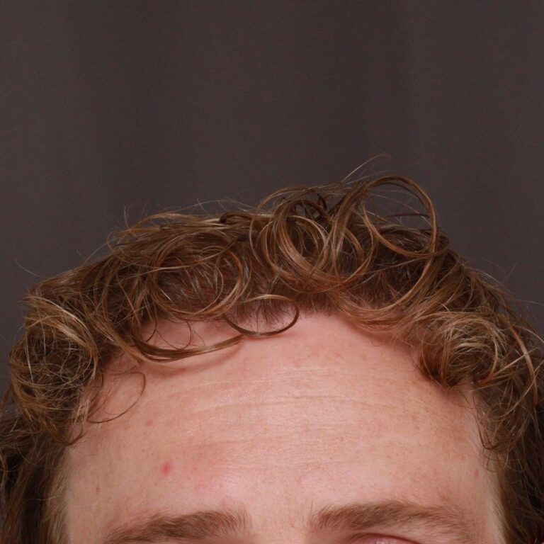 After Image: FUE Hair Transplant by Dr. Manning - front