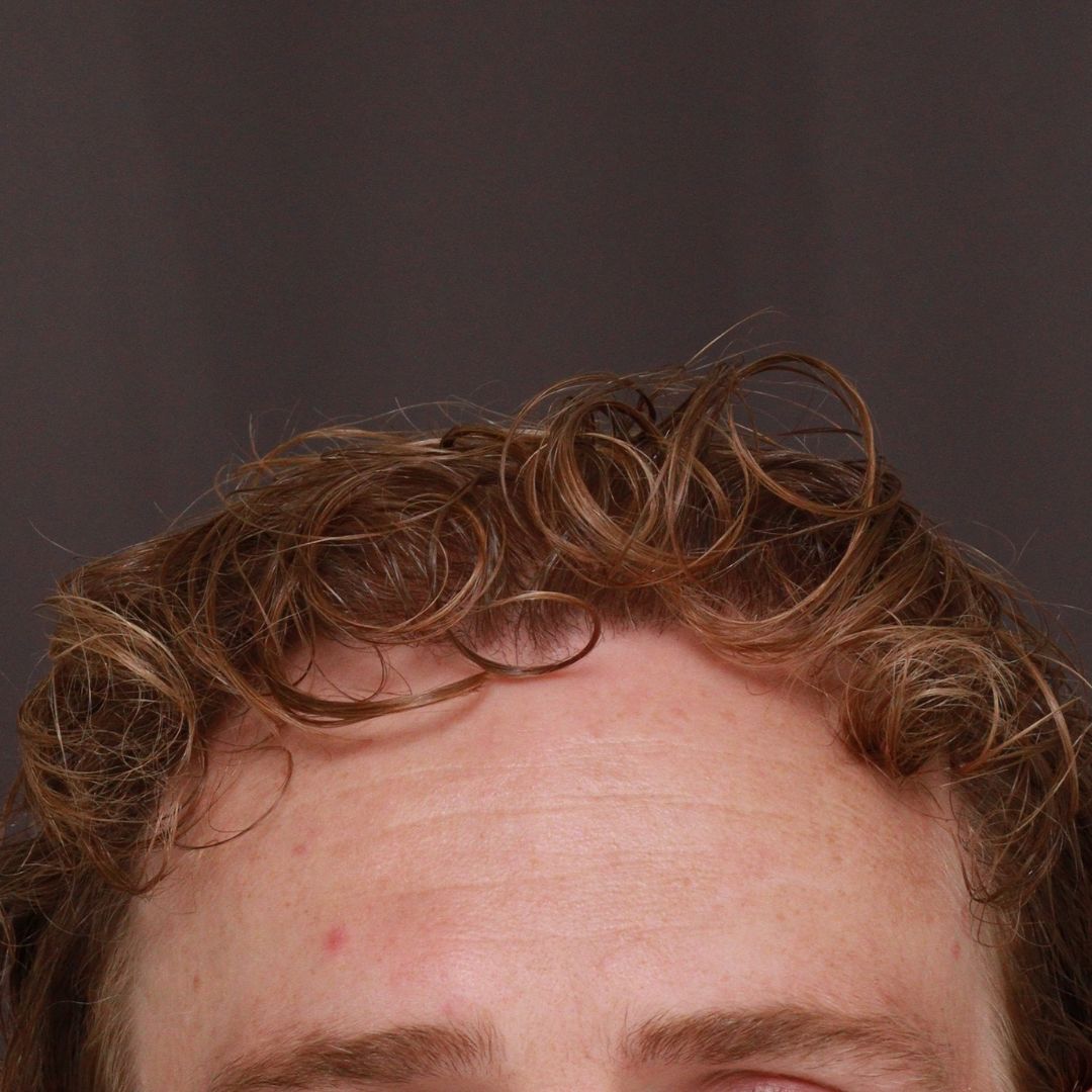 After Image: FUE Hair Transplant by Dr. Manning - front
