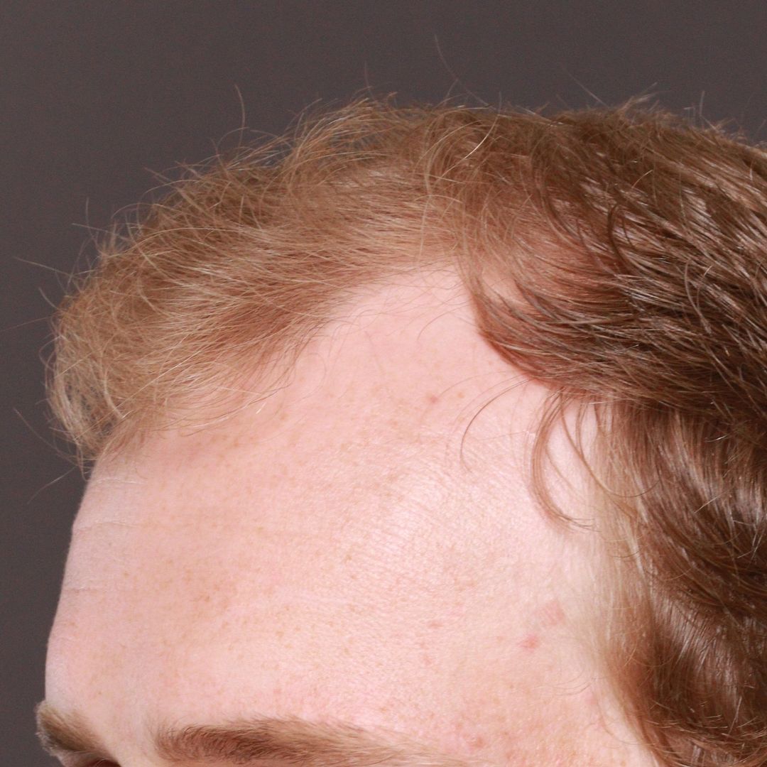 Before Image: FUE Hair Transplant by Dr. Manning - left-front-oblique