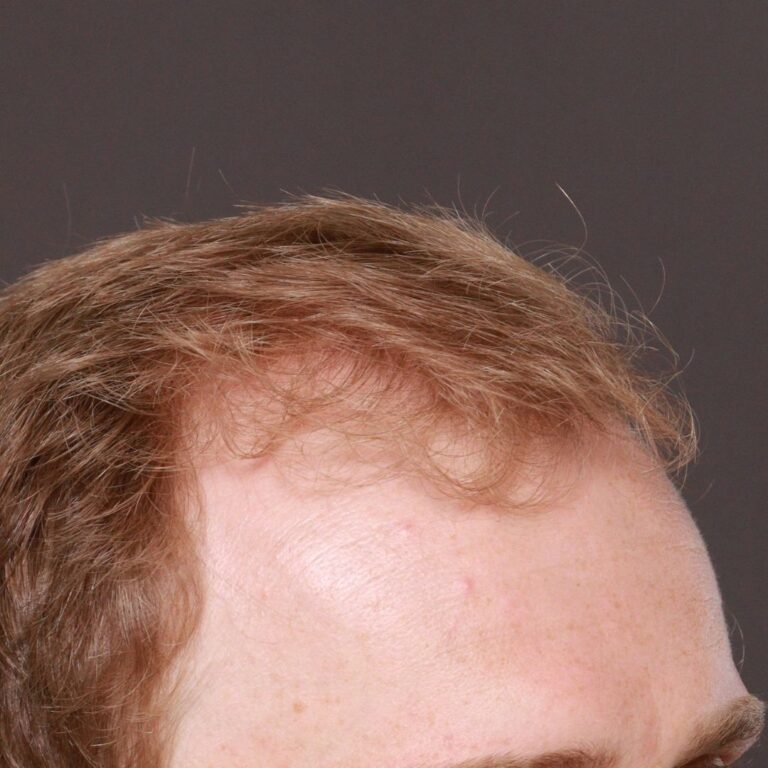 Before Image: FUE Hair Transplant by Dr. Manning - right-front-oblique