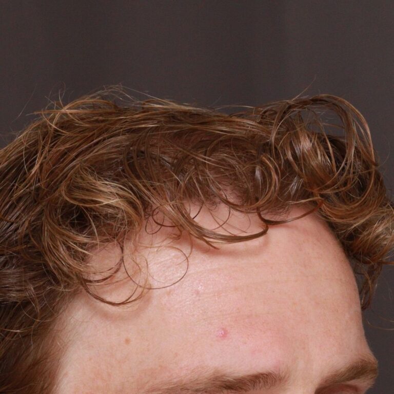 After Image: FUE Hair Transplant by Dr. Manning - right-front-oblique
