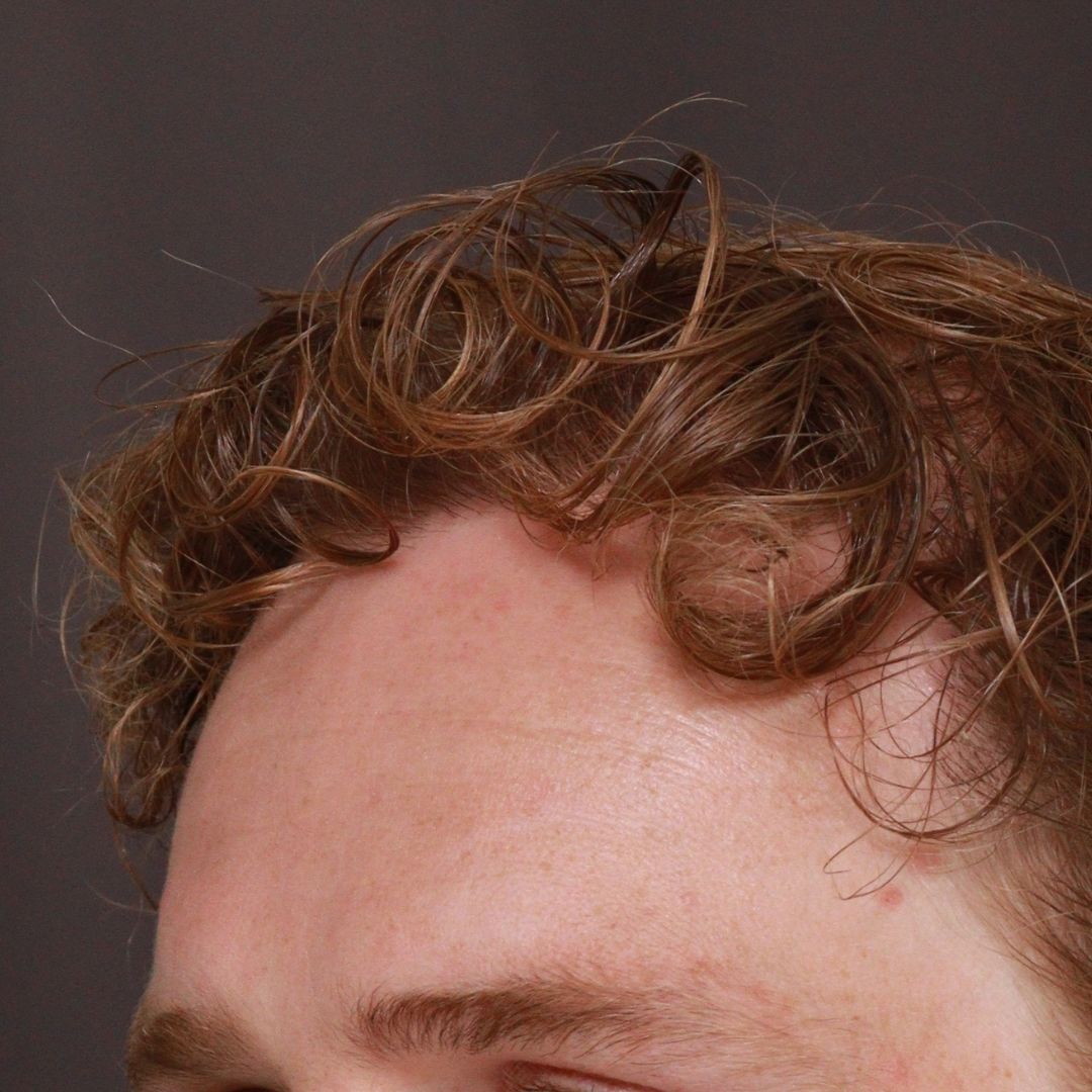 After Image: FUE Hair Transplant by Dr. Manning - left-front-oblique