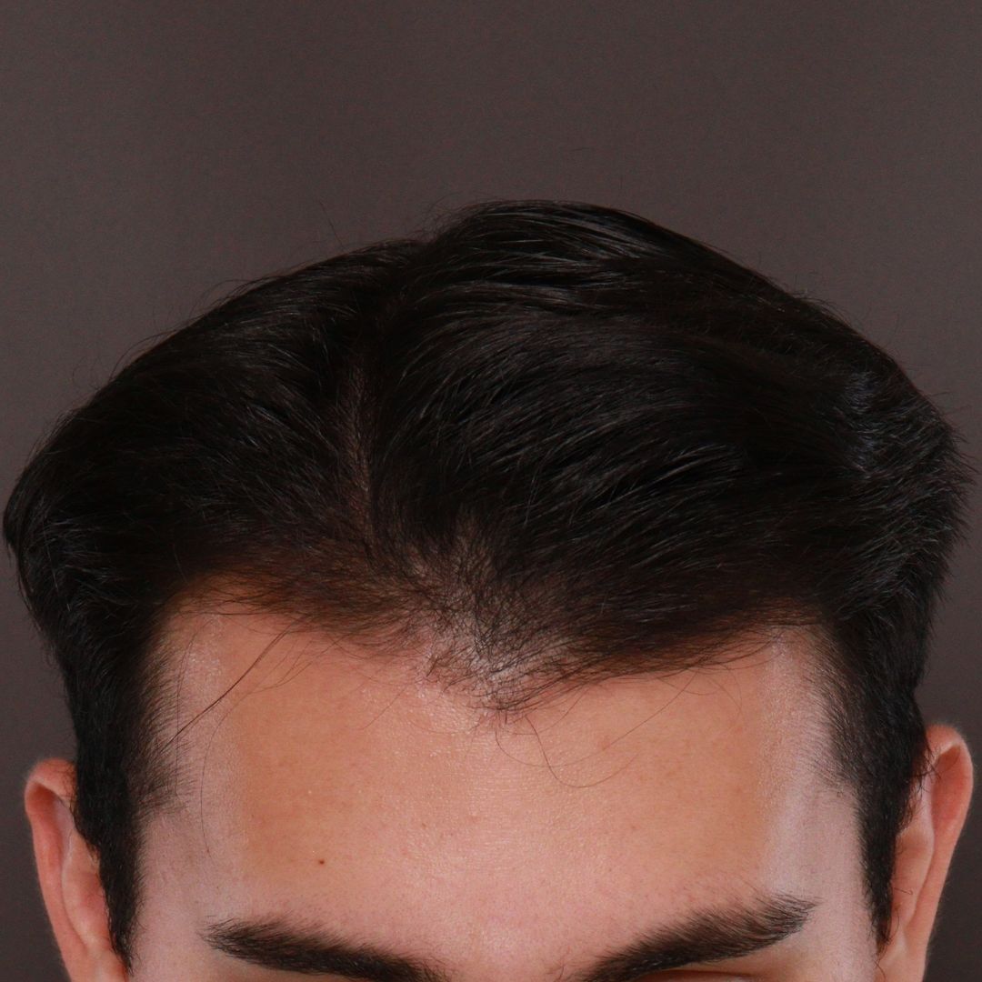 Before Image: FUE Hair Transplant by Dr. Manning - front
