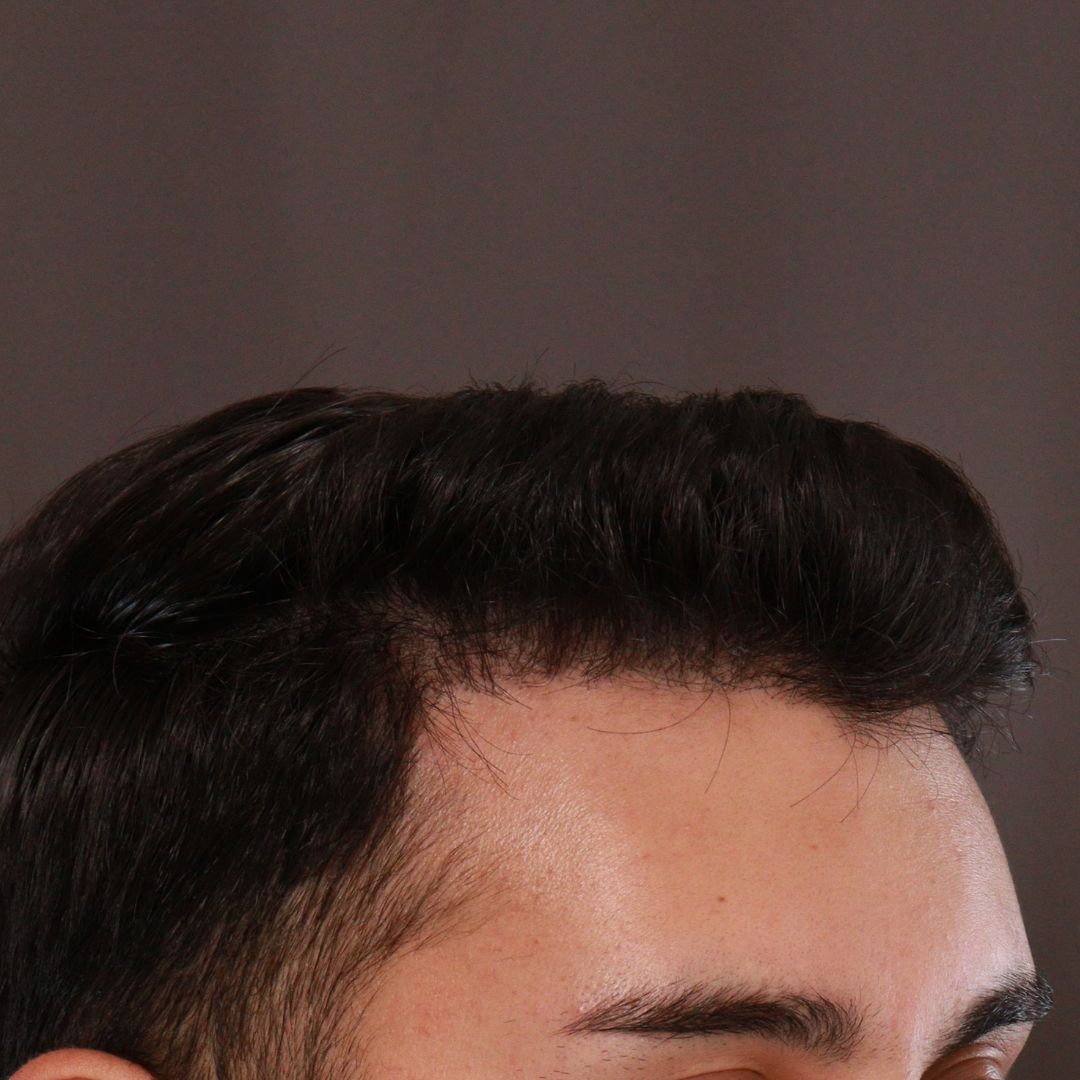 After Image: FUE Hair Transplant by Dr. Manning - left-front-oblique