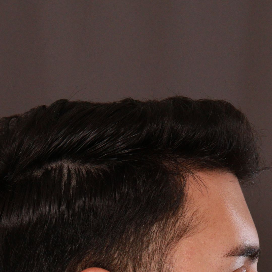 After Image: FUE Hair Transplant by Dr. Manning -
