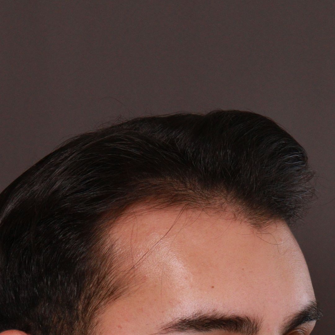 Before Image: FUE Hair Transplant by Dr. Manning - left-front-oblique