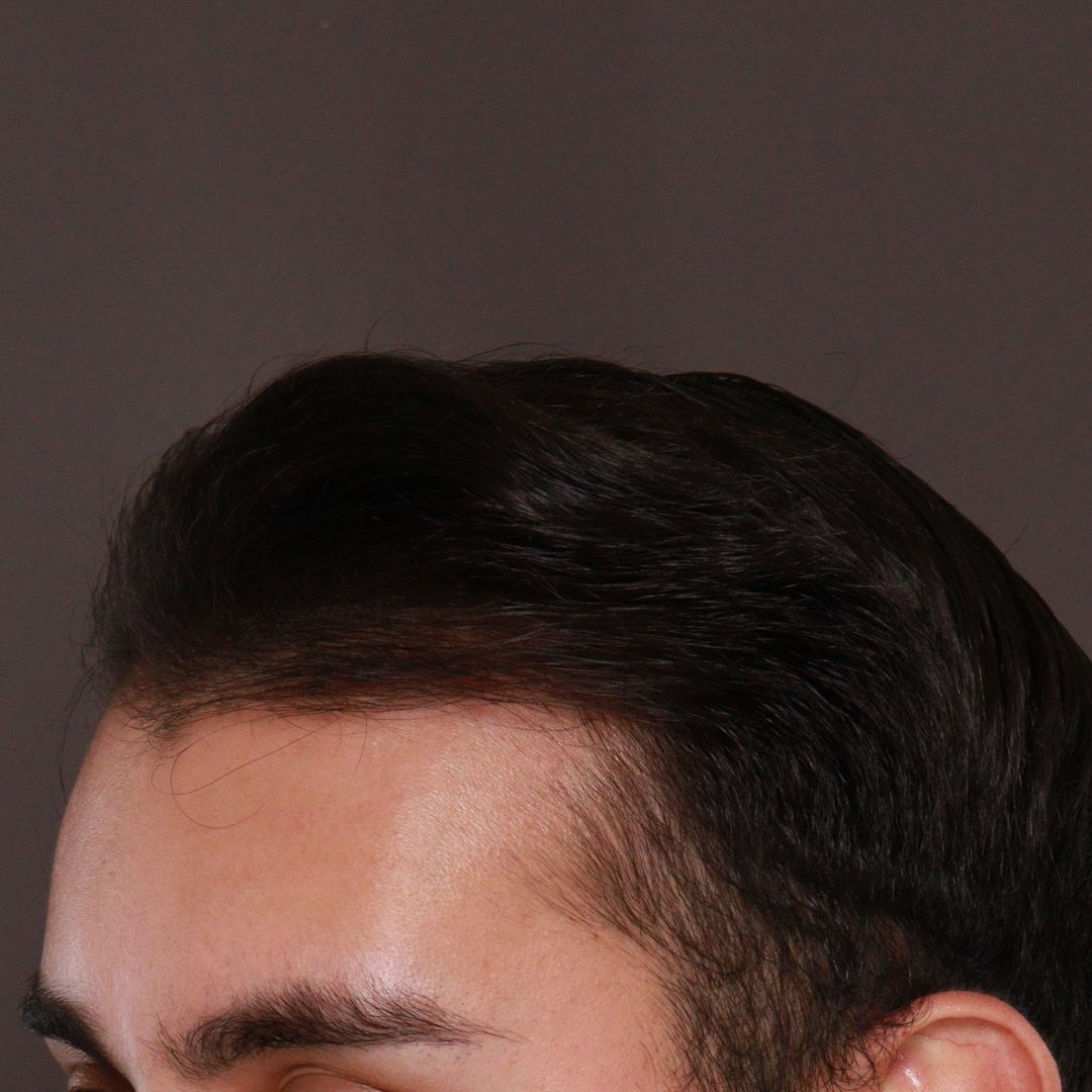 Before Image: FUE Hair Transplant by Dr. Manning - right-front-oblique