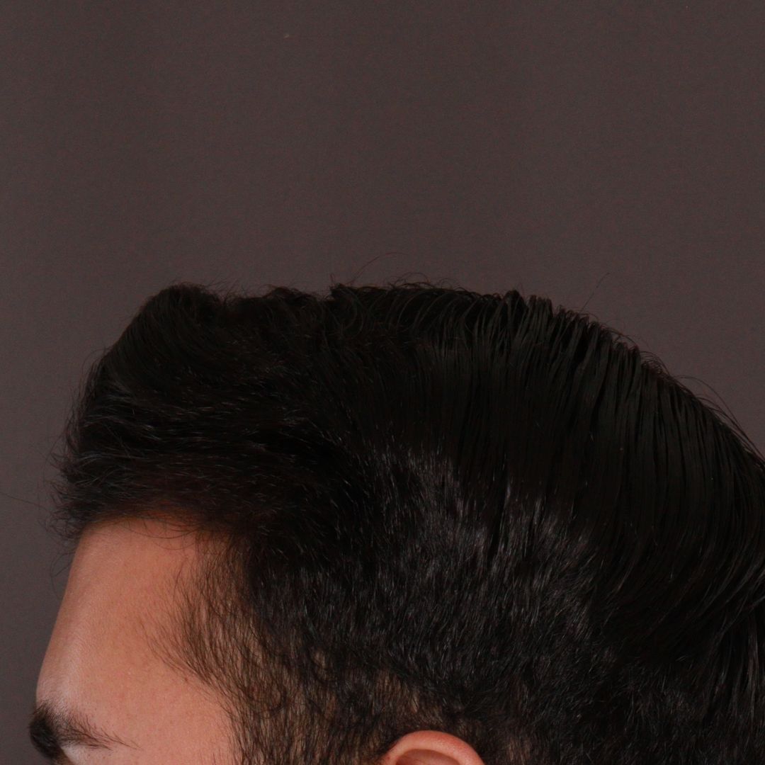 Before Image: FUE Hair Transplant by Dr. Manning -